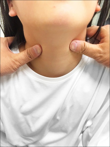 将大拇指置於气管两侧,请病人吞口水,以评估甲状腺是否肿大.